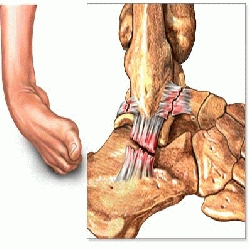 Ligamentoplastie Centre Orthop dique Pasteur Lanroze